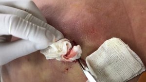 КАК ОН С ЭТИМ ЖИЛ?? | АБСЦЕДИРУЮЩИЙ КАРБУНКУЛ