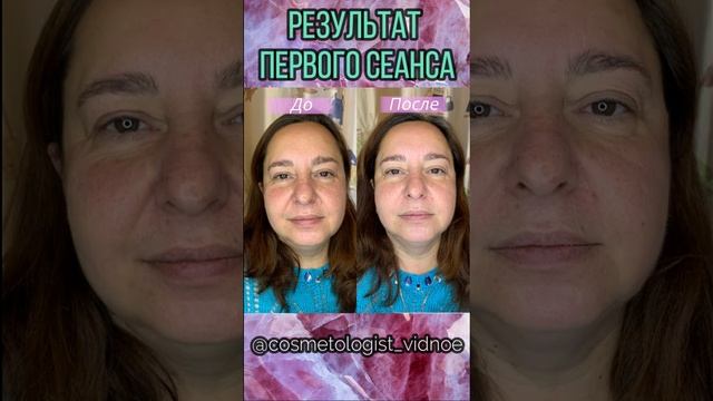 Лифтинг лица после одного сеанса | Магия массажа лица