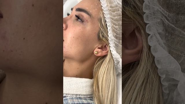 Процедура Atlantis lift - Разметка Atlantis lift смотреть онлайн