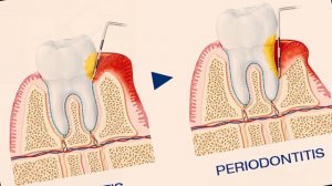 Как удалить зубной камень за 1 минуту в домашних условиях! [Профилактика кариеса, удаление налета]