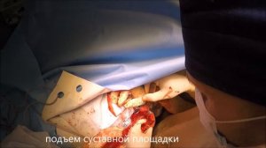 Перелом головки плечевой кости. Вывих плеча