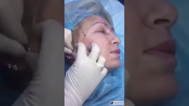Тредлифтинг . Нитевая подтяжка лица . Омоложение . Thread lifting