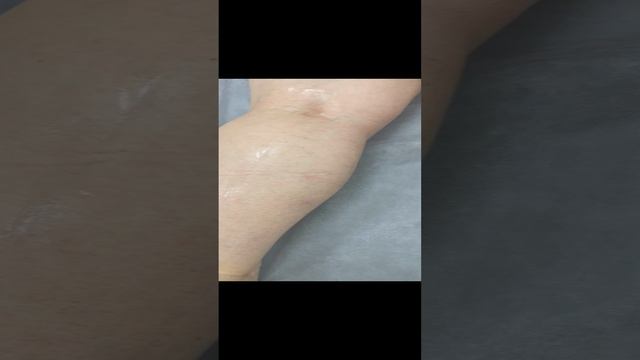 Миофасциальный синдром. Боли в ногах. Осмотр флеболога. Узи сосудов. Флеболог Москва. Флеболог. Узи