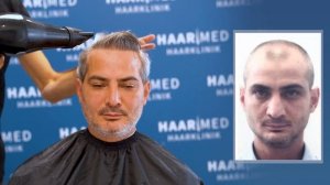 Haartransplantation in Deutschland - Haarmed Vorher / Nachher Ergebnis