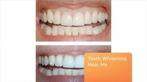 Florida Dental Care of Miller : Teeth Whitening Near You (305-596-0104)
