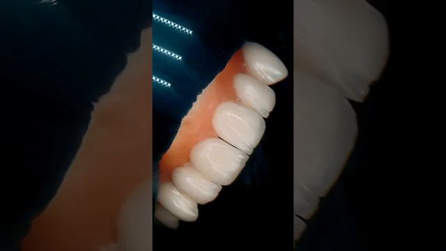 #Металлокерамика #dental #technical #dentalimplants #veneers #стоматология #нанесение #улыбка смотреть онлайн