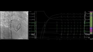 Linear Pulse field ablation Biotok