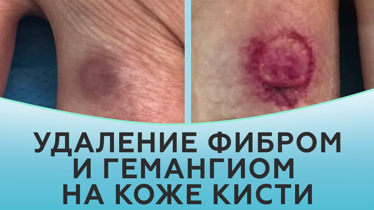 Удаление фибром и гемангиом на коже кисти