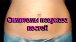 Признаки псориаза: первые симптомы у женщин, мужчин и детей
