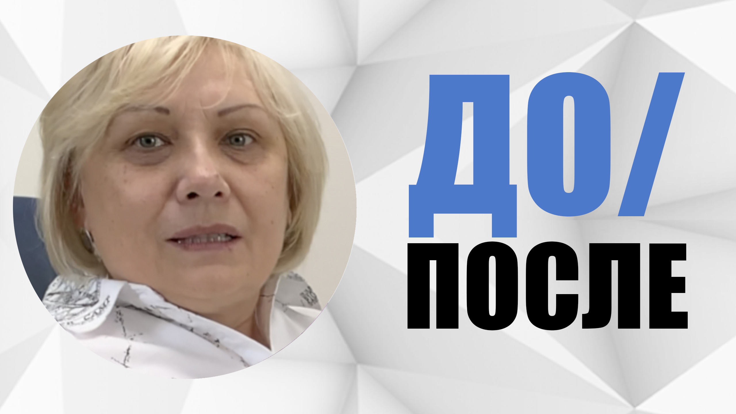 #5 Случай до/после. Имплантация зубов. Врач Гранцев Михаил Михайлович