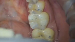 Фиксация циркониевой коронки , фиксация коронки из диоксида циркония , фиксация керамической коронк
