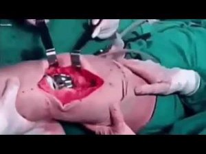 Эндопротез коленного сустава