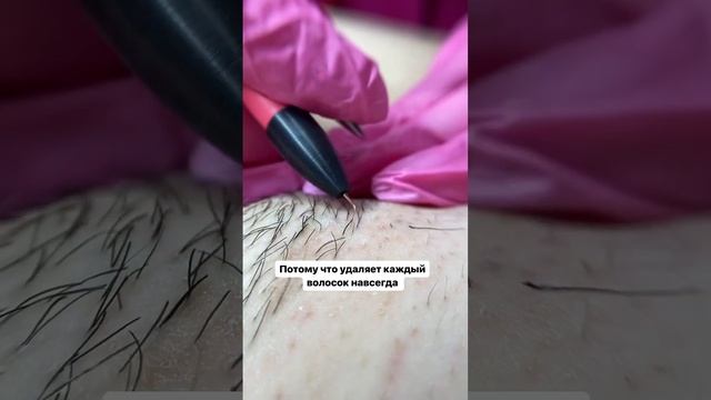 Кто-то приходит на процедуру после бритвы, а кто-то после лазера и шугаринга #электроэпиляциямосква