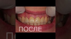 Восстановление эстетики передних зубов коронками из диоксида циркония