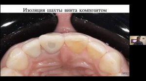 Урванцев - "Система одного абатмента (one abutment one time) MIS CONNECT"