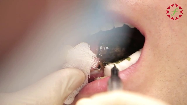 Применение фотодинамической терапии с фотосенсибилизатором Фотодитазин в стоматологии. смотреть онлайн