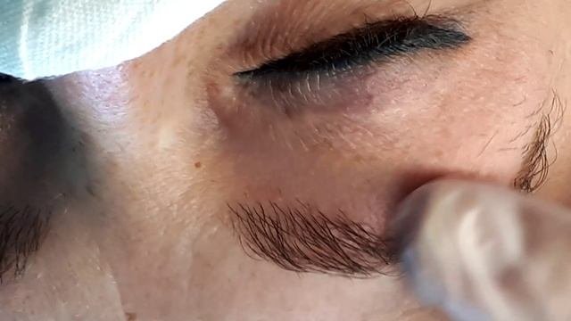 Электроэпиляция