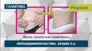 Липоабдоминопластика результат | Зазыбо Николай Александрович