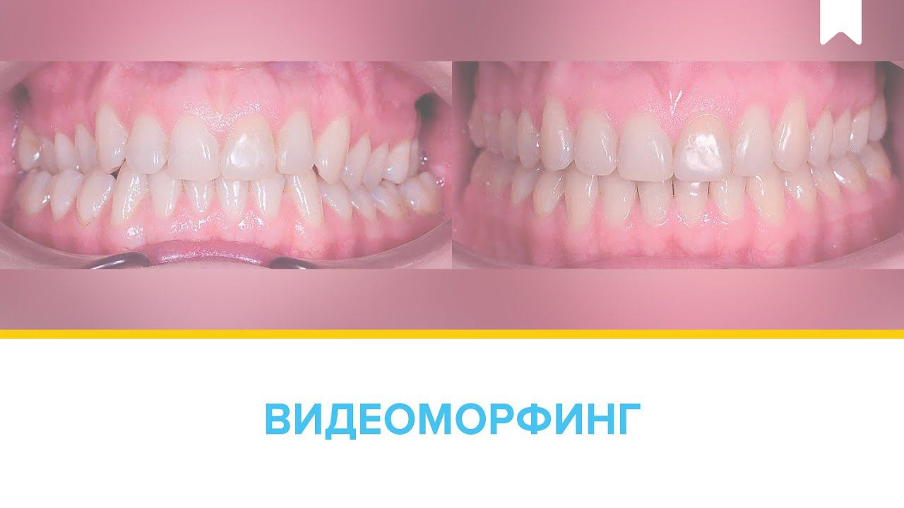 Лечение перекрестного прикуса металлическими брекетами Damon Q c  перекрестными эластиками.