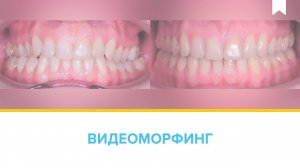 Лечение перекрестного прикуса металлическими брекетами Damon Q c  перекрестными эластиками.
