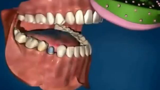 Циркониевые коронки на зубы (установка) смотреть онлайн