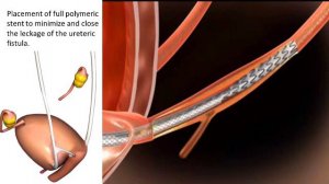 Dr. Joerg Neymeyer use of Allium Medical's Ureteral stent in a Fistula case