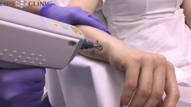 Удаление татуировок лазером смотреть онлайн