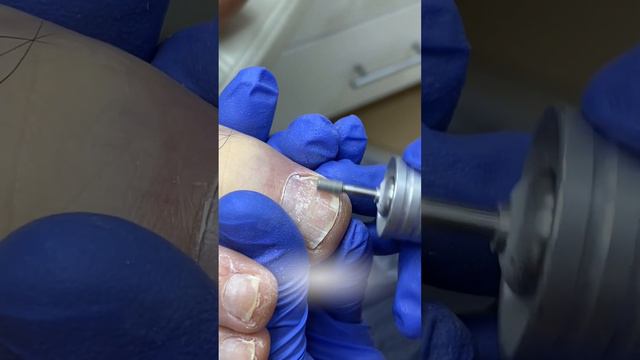 Педикюр для диабетиков