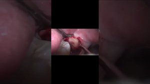 Удаление 8го зуба (зуб мудрости)