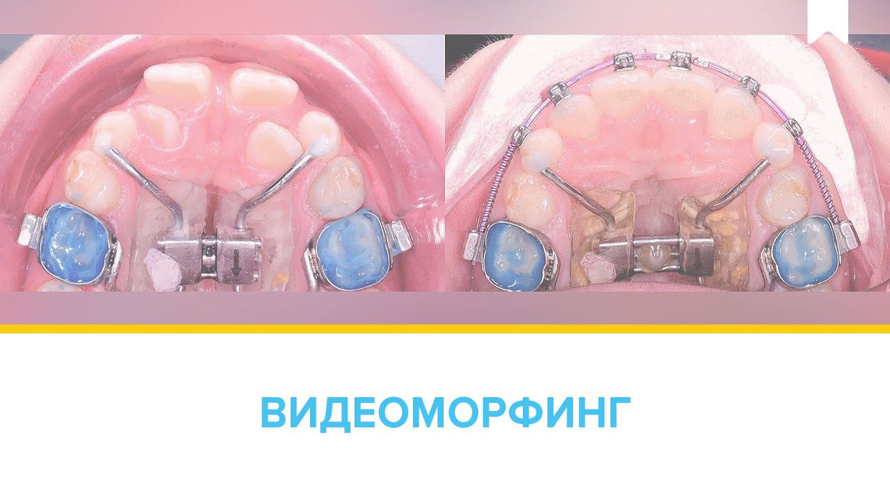 Лечение скученности в сменном прикусе: аппарат для быстрого нёбного расширения + частичная б/с