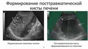 Ультразвуковая диагностика очаговых изменений печени