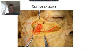 Анатомия скуловой зоны для косметологов