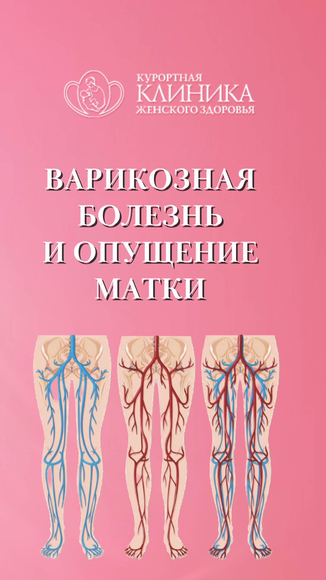 Варикоз и опущение матки #shorts