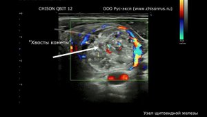 CHISON QBIT 12 (узел щитовидной железы)