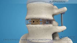 Установка межтелового кейджа и транспедикулярной фиксации смотреть онлайн