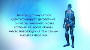 Эпидуральная стимуляция: Инновационная процедура пациентов с позвоночно -спинномозговой травмой