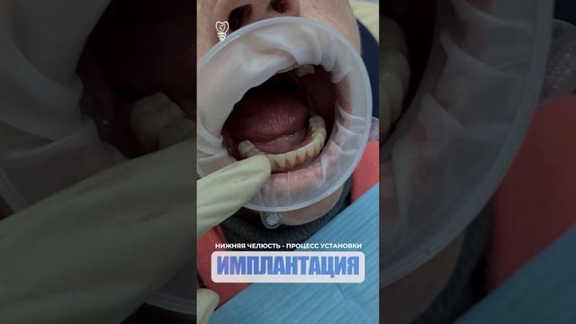 Нижняя челюсть - процесс установки. Lower jaw - the installation process. Implantation.