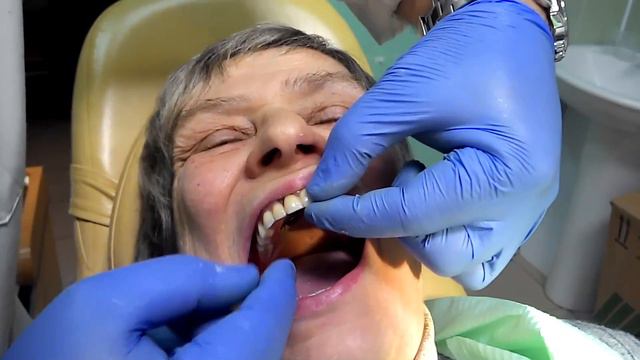 Принципиально новый бюгельный протез.Ч.4, через 7 лет смотреть онлайн