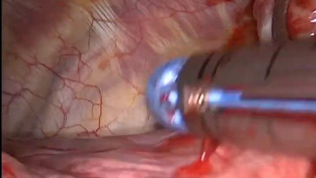 Мезотелиома плевры. Торакоскопия. Pleural Mesothelioma. Thoracoscopy.