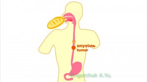 Опухоль пищевода(esophageal tumor): доброкачественная лейомиома (benign leiomioma).