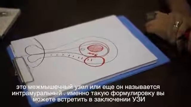 Миома часть 2 новый выпуск мифы в гинекологии смотреть онлайн