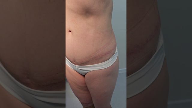 Абдоминопластика. Результат до/после