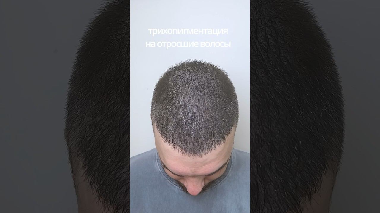 Трихопигментация на отросшие волосы после пересадки волос Уплотнили цвет Smp Scalp micropigmentation