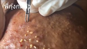 Удаление и выдавливание чёрных точек. Чистка лица. Выдавливание прыщей. Лечение акне. ЧАСТЬ 1