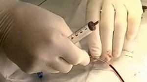 Установка катетера Сван Ганца (доступ через внутреннюю яремную вену)