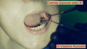 Снятие штампованной коронки 37. Кейс#1.
