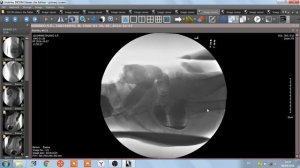 ИРРИГОСКОПИЯ  ИРРИГОГРАФИЯ  РЕНТГЕНОГРАФИЯ