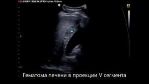 Гематома печени