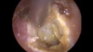 194: Eardrum about to 'EXPLODE' after Blocked Ear Wax Removal using Endoscopic Ear Microsuction