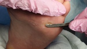 Стержневая мозоль. Аппаратный педикюр.